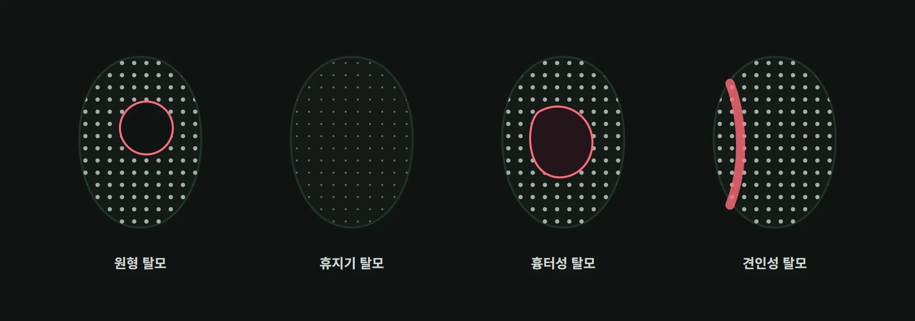 원형 탈모, 휴지기 탈모, 흉터성 탈모, 견인성 탈모의 모양 구분
