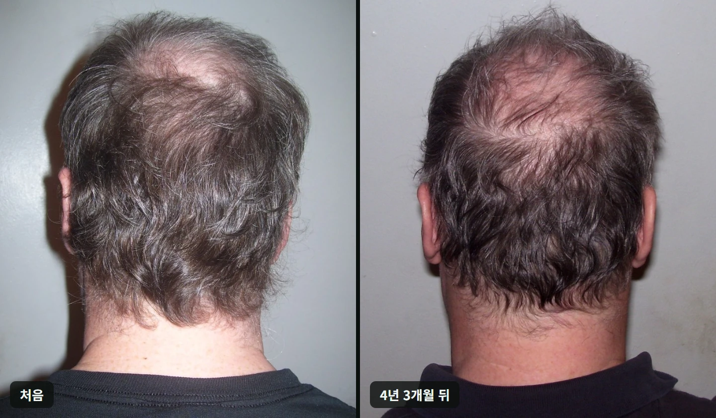 중년 남성의 뒤통수를 4년 3개월 간격으로 찍어 정수리 부위가 넓어진 것을 비교한 사진